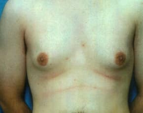 Male Breast Reduction Before & After Patient #856