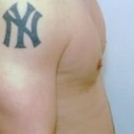Male Breast Reduction Before & After Patient #855