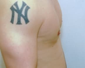 Male Breast Reduction Before & After Patient #855