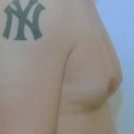 Male Breast Reduction Before & After Patient #855