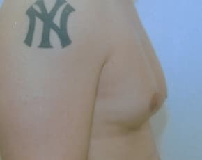 Male Breast Reduction Before & After Patient #855