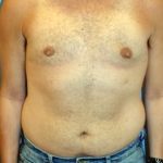 Male Breast Reduction Before & After Patient #854