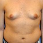 Male Breast Reduction Before & After Patient #854