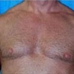 Male Breast Reduction Before & After Patient #853