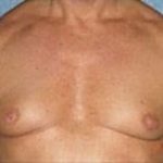 Male Breast Reduction Before & After Patient #853