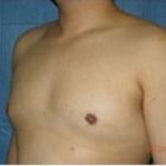 Male Breast Reduction Before & After Patient #852