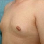 Male Breast Reduction Before & After Patient #852