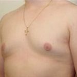 Male Breast Reduction Before & After Patient #851