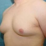 Male Breast Reduction Before & After Patient #851