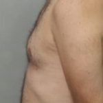 Male Breast Reduction Before & After Patient #850