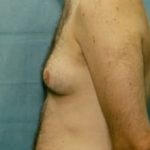 Male Breast Reduction Before & After Patient #850