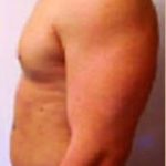 Male Breast Reduction Before & After Patient #849