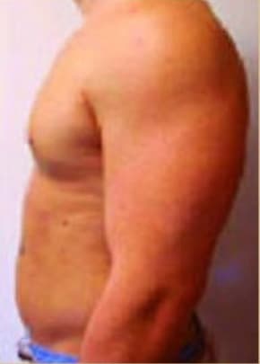 Male Breast Reduction Before & After Patient #849