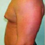 Male Breast Reduction Before & After Patient #849