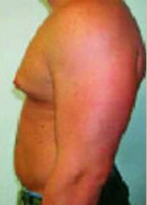 Male Breast Reduction Before & After Patient #849
