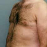 Male Breast Reduction Before & After Patient #848
