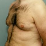 Male Breast Reduction Before & After Patient #848