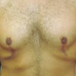 Male Breast Reduction Before & After Patient #847