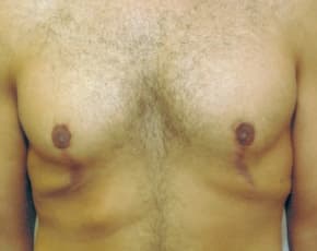 Male Breast Reduction Before & After Patient #847