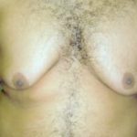 Male Breast Reduction Before & After Patient #847
