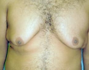 Male Breast Reduction Before & After Patient #847