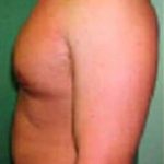 Male Breast Reduction Before & After Patient #846