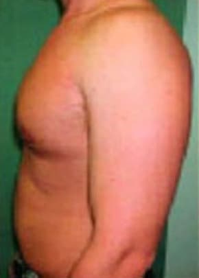 Male Breast Reduction Before & After Patient #846