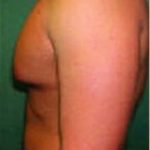 Male Breast Reduction Before & After Patient #846