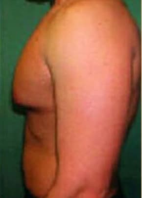 Male Breast Reduction Before & After Patient #846