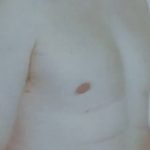 Male Breast Reduction Before & After Patient #845