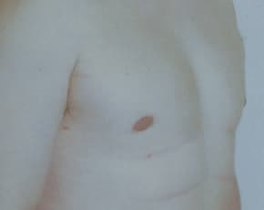 Male Breast Reduction Before & After Patient #845