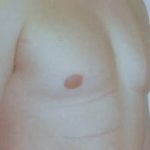 Male Breast Reduction Before & After Patient #845