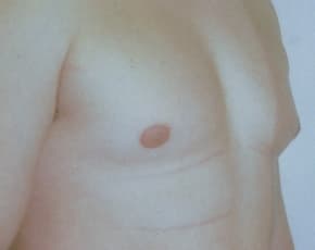 Male Breast Reduction Before & After Patient #845