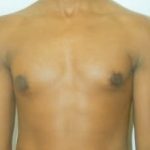 Male Breast Reduction Before & After Patient #844