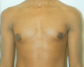 Male Breast Reduction Before & After Patient #844