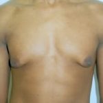 Male Breast Reduction Before & After Patient #844