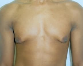Male Breast Reduction Before & After Patient #844