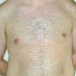 Breast Before & After Patient #843