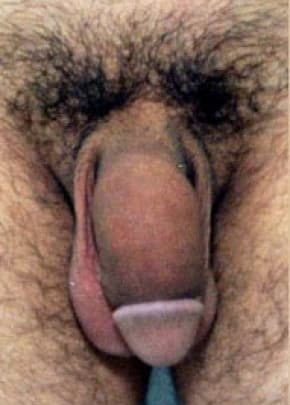 Male Enhancement Before & After Patient #1300