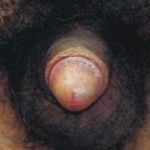 Male Enhancement Before & After Patient #1300