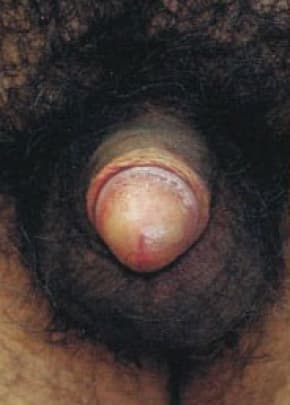 Male Enhancement Before & After Patient #1300