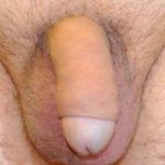 Male Enhancement Before & After Patient #1296