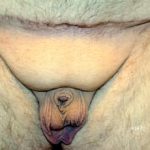 Male Enhancement Before & After Patient #1292