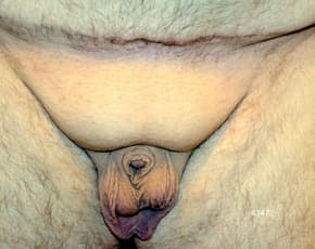 Male Enhancement Before & After Patient #1292