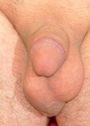 Male Enhancement Before & After Patient #1291