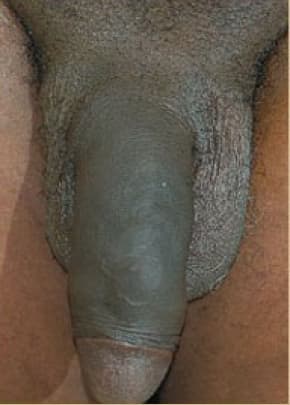 Male Enhancement Before & After Patient #1289