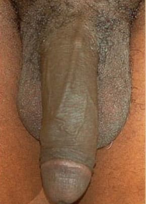 Male Enhancement Before & After Patient #1289