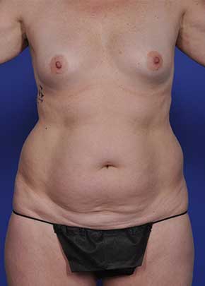 Mommy Makeover Before & After Patient #1226