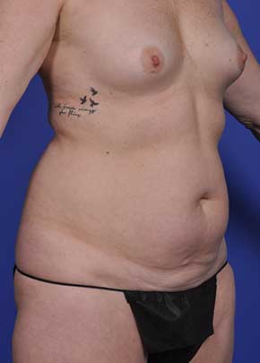 Mommy Makeover Before & After Patient #1226