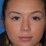 Rhinoplasty Before & After Patient #1602
